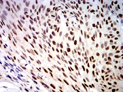 Figure 9:Immunohistochemical analysis of paraffin-embedded esophageal cancer tissues using DDX1 mouse mAb with DAB staining.