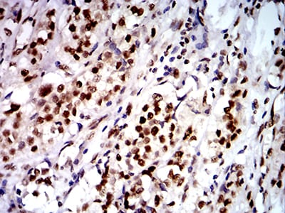 Figure 8:Immunohistochemical analysis of paraffin-embedded bladder cancer tissues using DDX1 mouse mAb with DAB staining.