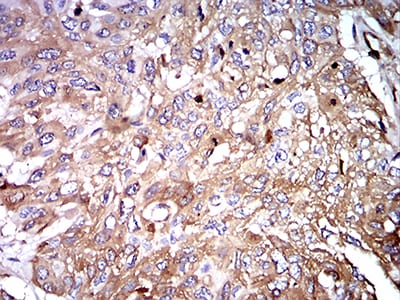 Figure 6:Immunohistochemical analysis of paraffin-embedded esophageal cancer tissues using IghA1 mouse mAb with DAB staining.