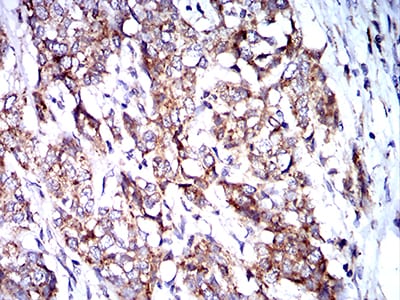 Figure 6:Immunohistochemical analysis of paraffin-embedded breast cancer tissues using BNIP3 mouse mAb with DAB staining.