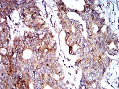 Figure 7:Immunohistochemical analysis of paraffin-embedded rectum cancer tissues using BNIP3 mouse mAb with DAB staining.