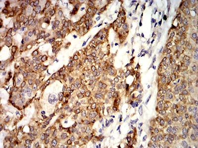 Figure 5:Immunohistochemical analysis of paraffin-embedded bladder cancer tissues using AGR2 mouse mAb with DAB staining.