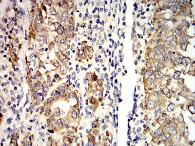 Figure 6:Immunohistochemical analysis of paraffin-embedded stomach cancer tissues using AGR2 mouse mAb with DAB staining.
