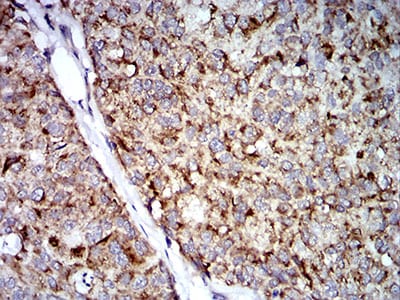 Figure 7:Immunohistochemical analysis of paraffin-embedded bladder cancer tissues using TRIM25 mouse mAb with DAB staining.