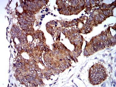 Figure 8:Immunohistochemical analysis of paraffin-embedded rectum cancer tissues using TRIM25 mouse mAb with DAB staining.