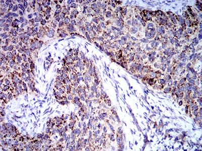 Figure 7:Immunohistochemical analysis of paraffin-embedded cervical cancer tissues using TRIM25 mouse mAb with DAB staining.