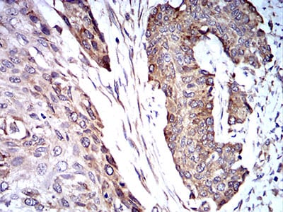 Figure 8:Immunohistochemical analysis of paraffin-embedded esophageal cancer tissues using TRIM25 mouse mAb with DAB staining.