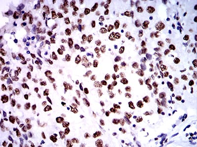 Figure 8:Immunohistochemical analysis of paraffin-embedded ovarian cancer tissues using ZFP91 mouse mAb with DAB staining.