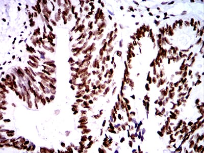 Figure 9:Immunohistochemical analysis of paraffin-embedded rectum cancer tissues using ZFP91 mouse mAb with DAB staining.
