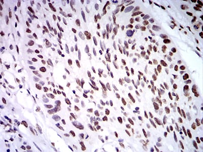 Figure 9:Immunohistochemical analysis of paraffin-embedded esophageal cancer tissues using ZFP91 mouse mAb with DAB staining.