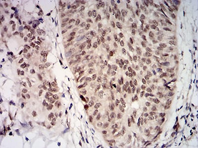Figure 6:Immunohistochemical analysis of paraffin-embedded bladder cancer tissues using UL37 mouse mAb with DAB staining.