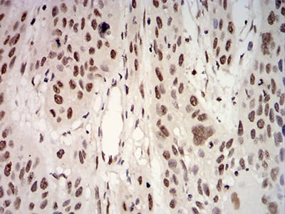 Figure 7:Immunohistochemical analysis of paraffin-embedded esophageal cancer tissues using UL37 mouse mAb with DAB staining.