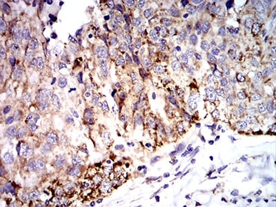 Figure 6:Immunohistochemical analysis of paraffin-embedded ovarian cancer tissues using SOD2 mouse mAb with DAB staining.