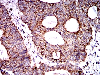 Figure 7:Immunohistochemical analysis of paraffin-embedded rectum cancer tissues using SOD2 mouse mAb with DAB staining.