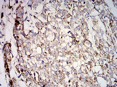 Figure 6:Immunohistochemical analysis of paraffin-embedded breast cancer tissues using SOD2 mouse mAb with DAB staining.