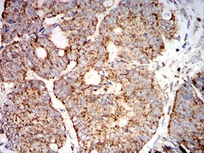 Figure 7:Immunohistochemical analysis of paraffin-embedded rectum cancer tissues using SOD2 mouse mAb with DAB staining.