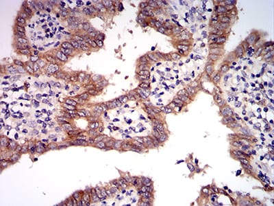 Figure 7:Immunohistochemical analysis of paraffin-embedded endometrial cancer tissues using MET mouse mAb with DAB staining.