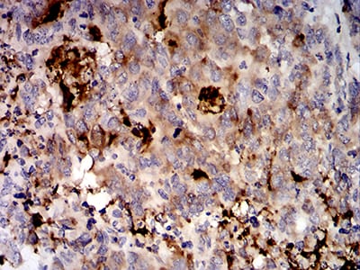 Figure 5:Immunohistochemical analysis of paraffin-embedded stomach cancer tissues using MUC5AC mouse mAb with DAB staining.