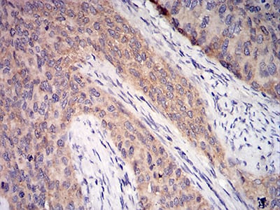 Figure 5:Immunohistochemical analysis of paraffin-embedded cervical cancer tissues using C1QA mouse mAb with DAB staining.