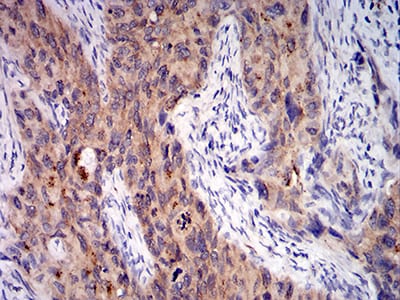 Figure 5:Immunohistochemical analysis of paraffin-embedded cervical cancer tissues using C1QA mouse mAb with DAB staining.