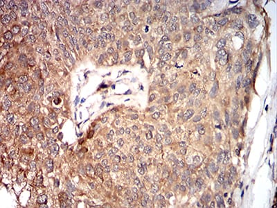 Figure 7:Immunohistochemical analysis of paraffin-embedded bladder cancer tissues using VP2 mouse mAb with DAB staining.