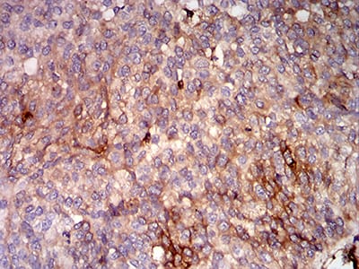 Figure 9:Immunohistochemical analysis of paraffin-embedded bladder cancer tissues using HLA-B mouse mAb with DAB staining.