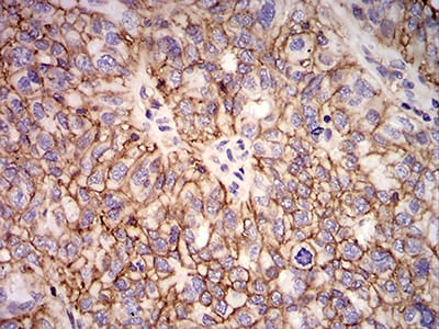 Figure 6:Immunohistochemical analysis of paraffin-embedded ovarian cancer tissues using HLA-B mouse mAb with DAB staining.