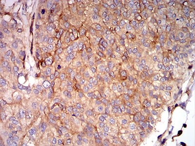 Figure 7:Immunohistochemical analysis of paraffin-embedded bladder cancer tissues using HLA-B mouse mAb with DAB staining.