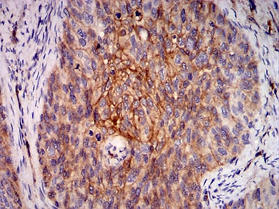 Figure 6:Immunohistochemical analysis of paraffin-embedded cervical cancer tissues using RALB mouse mAb with DAB staining.