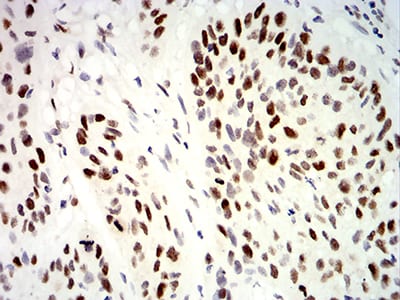 Figure 5:Immunohistochemical analysis of paraffin-embedded esophageal cancer tissues using UHRF1 mouse mAb with DAB staining.