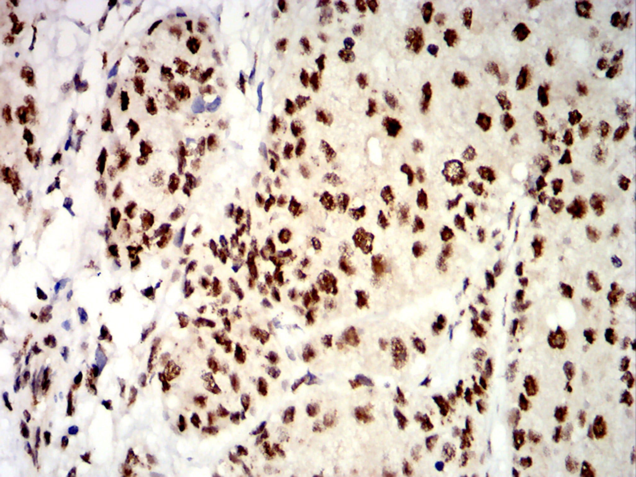 Figure 8:Immunohistochemical analysis of paraffin-embedded bladder cancer tissues using UHRF1 mouse mAb with DAB staining.