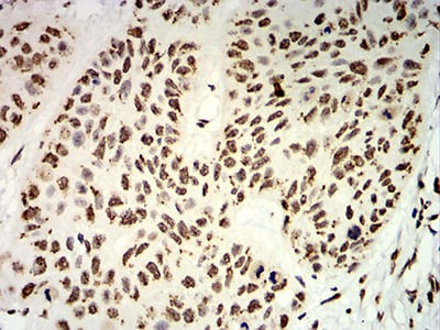 Figure 9:Immunohistochemical analysis of paraffin-embedded esophageal cancer tissues using UHRF1 mouse mAb with DAB staining.