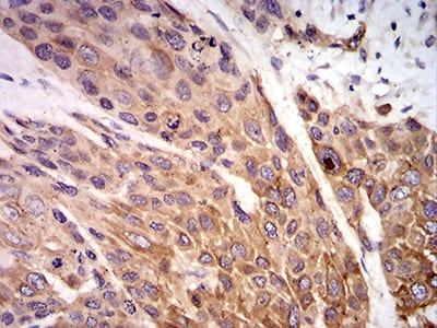 Figure 6:Immunohistochemical analysis of paraffin-embedded esophageal cancer tissues using P2RX7 mouse mAb with DAB staining.