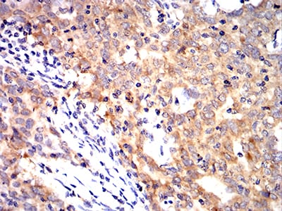 Figure 6:Immunohistochemical analysis of paraffin-embedded breast cancer tissues using KRT10 mouse mAb with DAB staining.