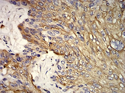Figure 7:Immunohistochemical analysis of paraffin-embedded esophageal cancer tissues using KRT10 mouse mAb with DAB staining.