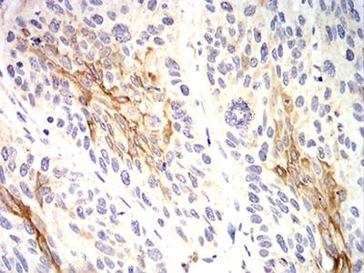 Figure 6:Immunohistochemical analysis of paraffin-embedded esophageal cancer tissues using KRT10 mouse mAb with DAB staining.