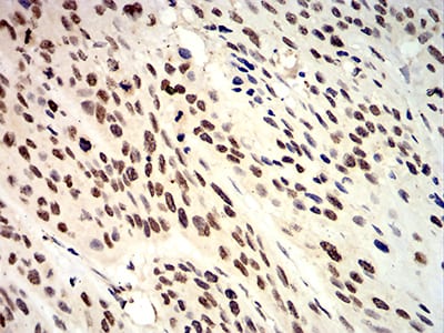 Figure 7:Immunohistochemical analysis of paraffin-embedded esophageal cancer tissues using ANAPC10 mouse mAb with DAB staining.