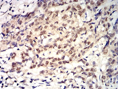 Figure 5:Immunohistochemical analysis of paraffin-embedded breast cancer tissues using ROP1 mouse mAb with DAB staining.