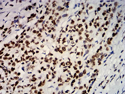 Figure 8:Immunohistochemical analysis of paraffin-embedded breast cancer tissues using ESR1 mouse mAb with DAB staining.