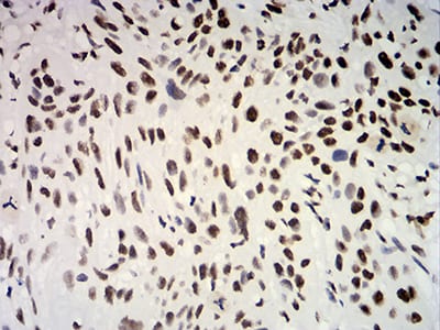 Figure 9:Immunohistochemical analysis of paraffin-embedded esophageal cancer tissues using ESR1 mouse mAb with DAB staining.