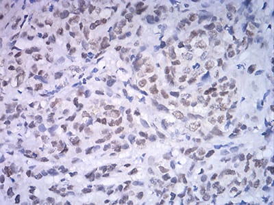 Figure 5:Immunohistochemical analysis of paraffin-embedded breast cancer tissues using ATF4 mouse mAb with DAB staining.