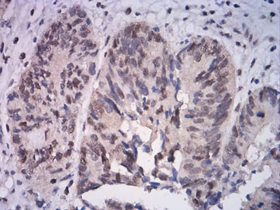 Figure 6:Immunohistochemical analysis of paraffin-embedded rectum cancer tissues using ATF4 mouse mAb with DAB staining.