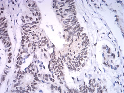 Figure 7:Immunohistochemical analysis of paraffin-embedded rectum cancer tissues using ASH2L mouse mAb with DAB staining.