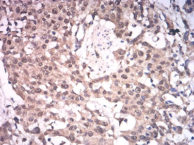 Figure 4:Immunohistochemical analysis of paraffin-embedded esophageal cancer tissues using ASH2L mouse mAb with DAB staining.