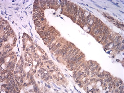 Figure 5:Immunohistochemical analysis of paraffin-embedded rectum cancer tissues using ASH2L mouse mAb with DAB staining.