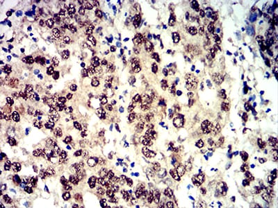 Figure 3:Immunohistochemical analysis of paraffin-embedded stomach cancer tissues using Phospho-4E-BP1 (Ser65) mouse mAb with DAB staining.