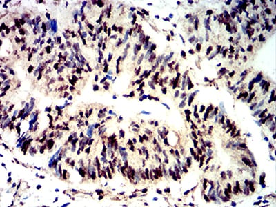 Figure 4:Immunohistochemical analysis of paraffin-embedded rectum cancer tissues using Phospho-4E-BP1 (Ser65) mouse mAb with DAB staining.