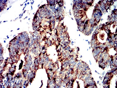 Figure 7:Immunohistochemical analysis of paraffin-embedded rectum cancer tissues using PRKAA2 mouse mAb with DAB staining.