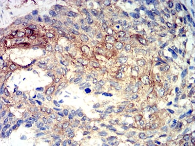 Figure 4:Immunohistochemical analysis of paraffin-embedded esophageal cancer tissues using PRKAA2 mouse mAb with DAB staining.