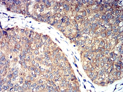 Figure 7:Immunohistochemical analysis of paraffin-embedded ROP1 tissues using bladder cancer mouse mAb with DAB staining.